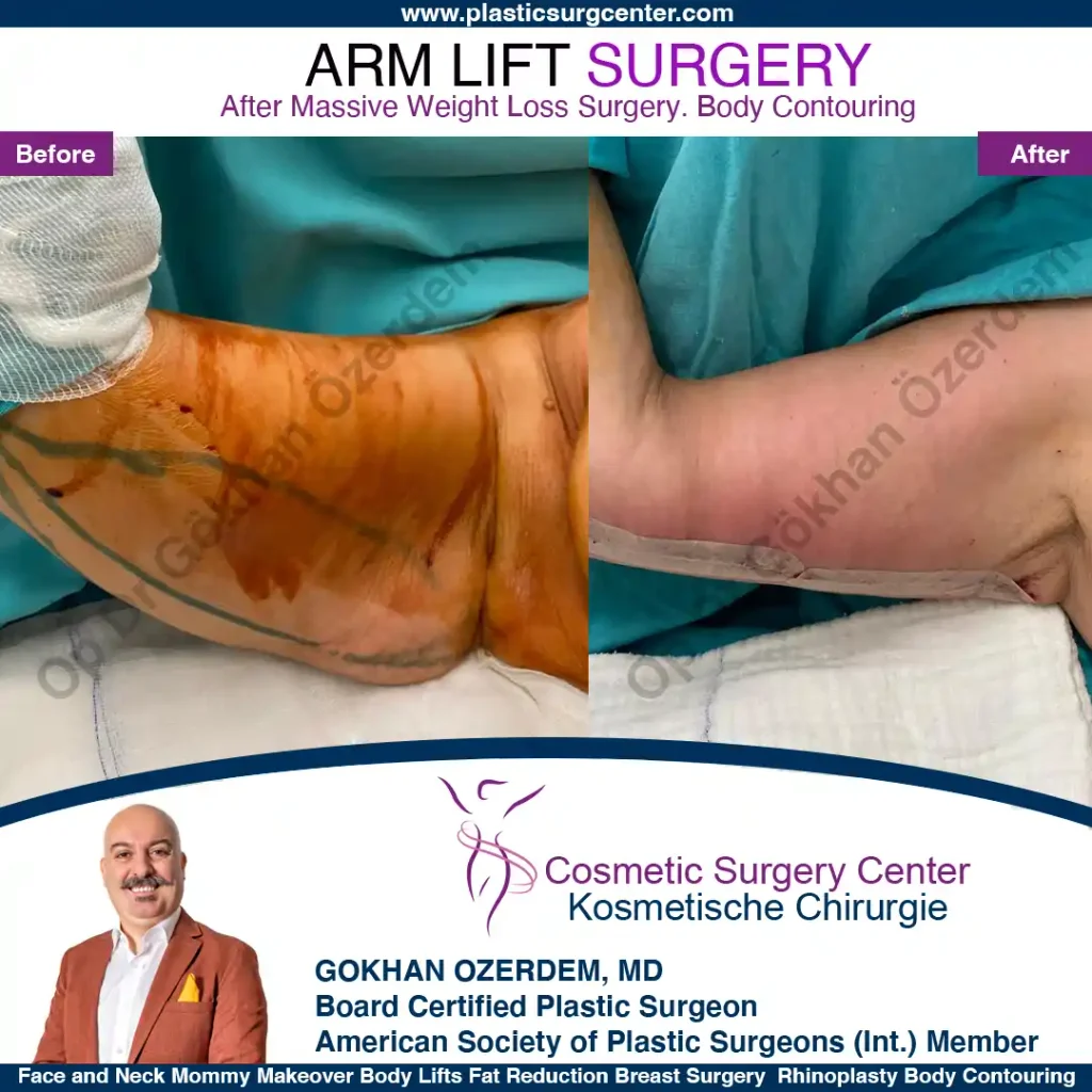 Arm Lift in Turkey, Case 4 - Right Arm