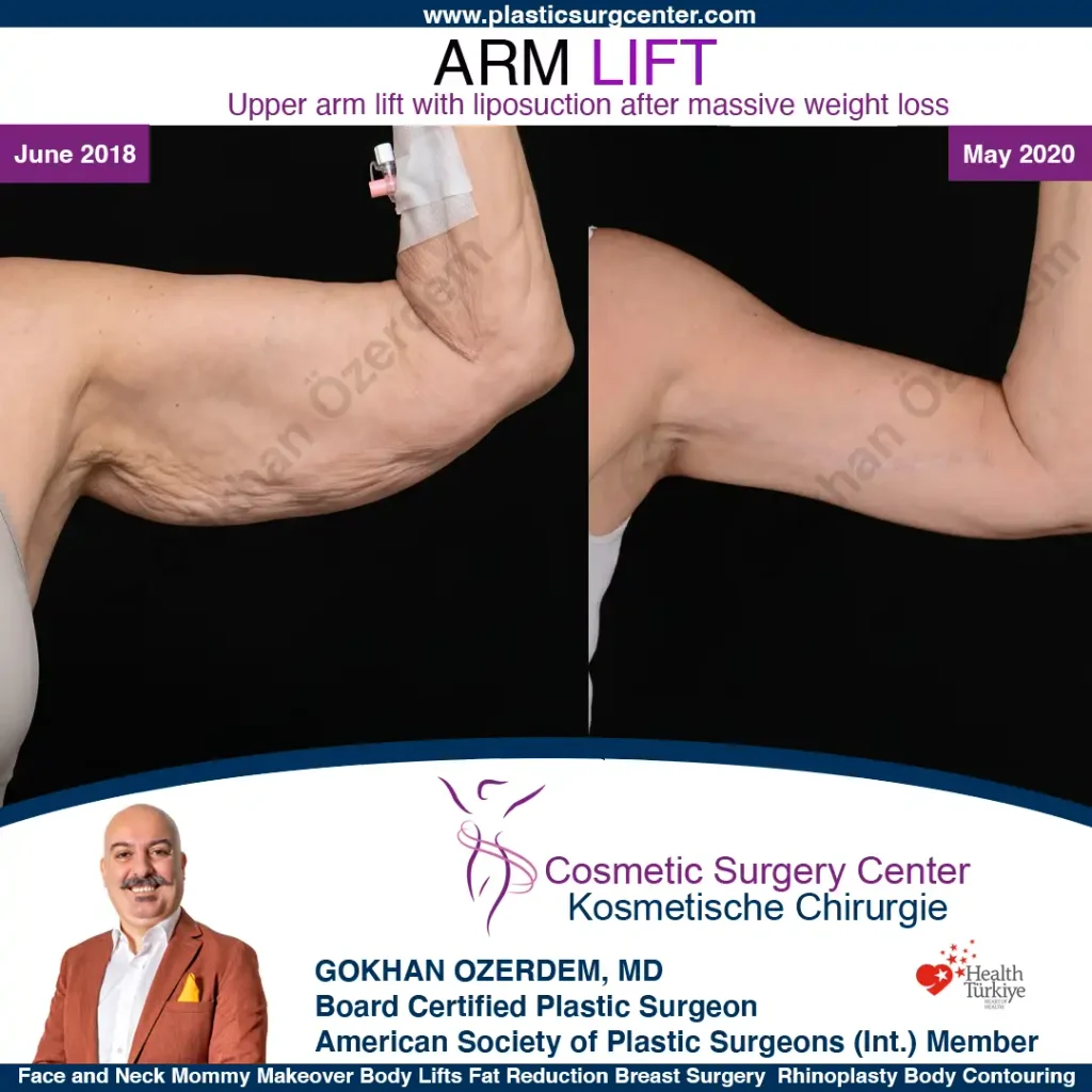 Arm Lift in Turkey, Case 12 - Left Arm