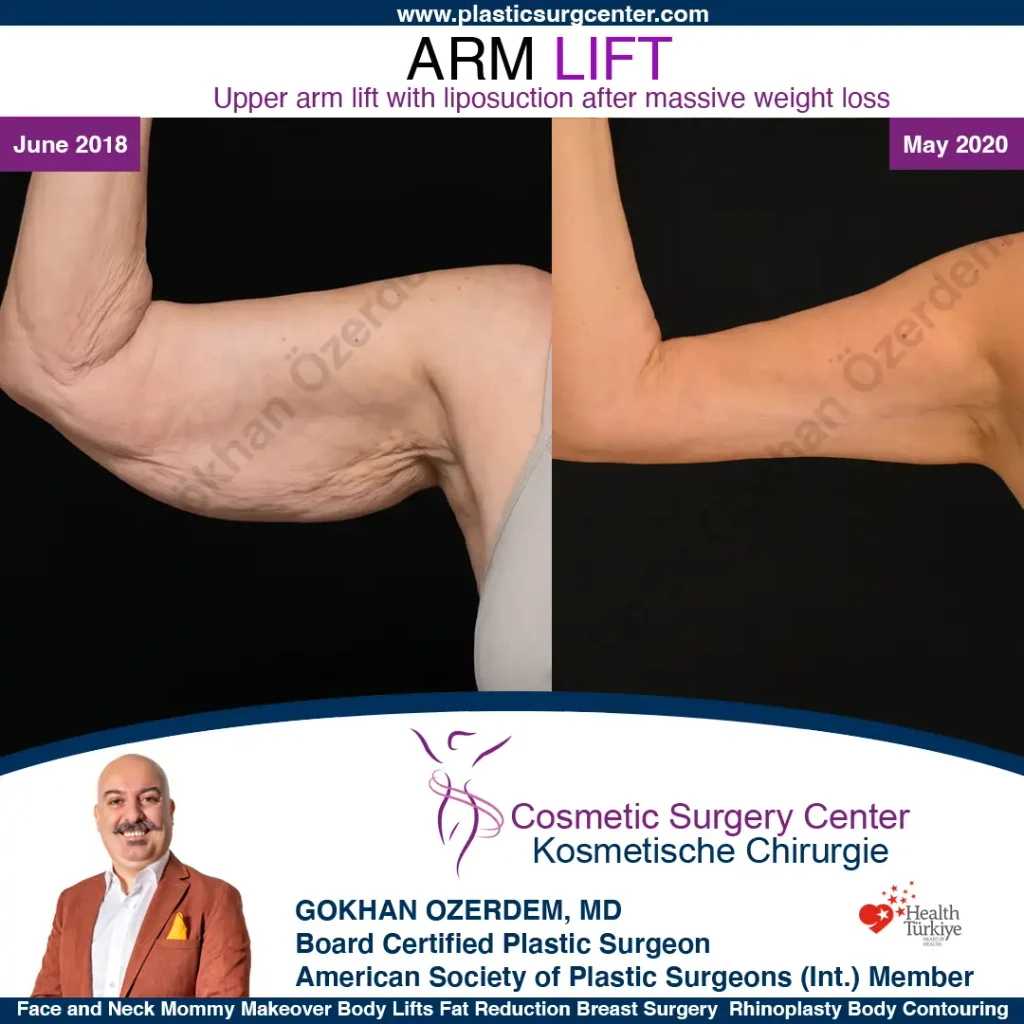 Arm Lift in Turkey, Case 12 - Right Arm