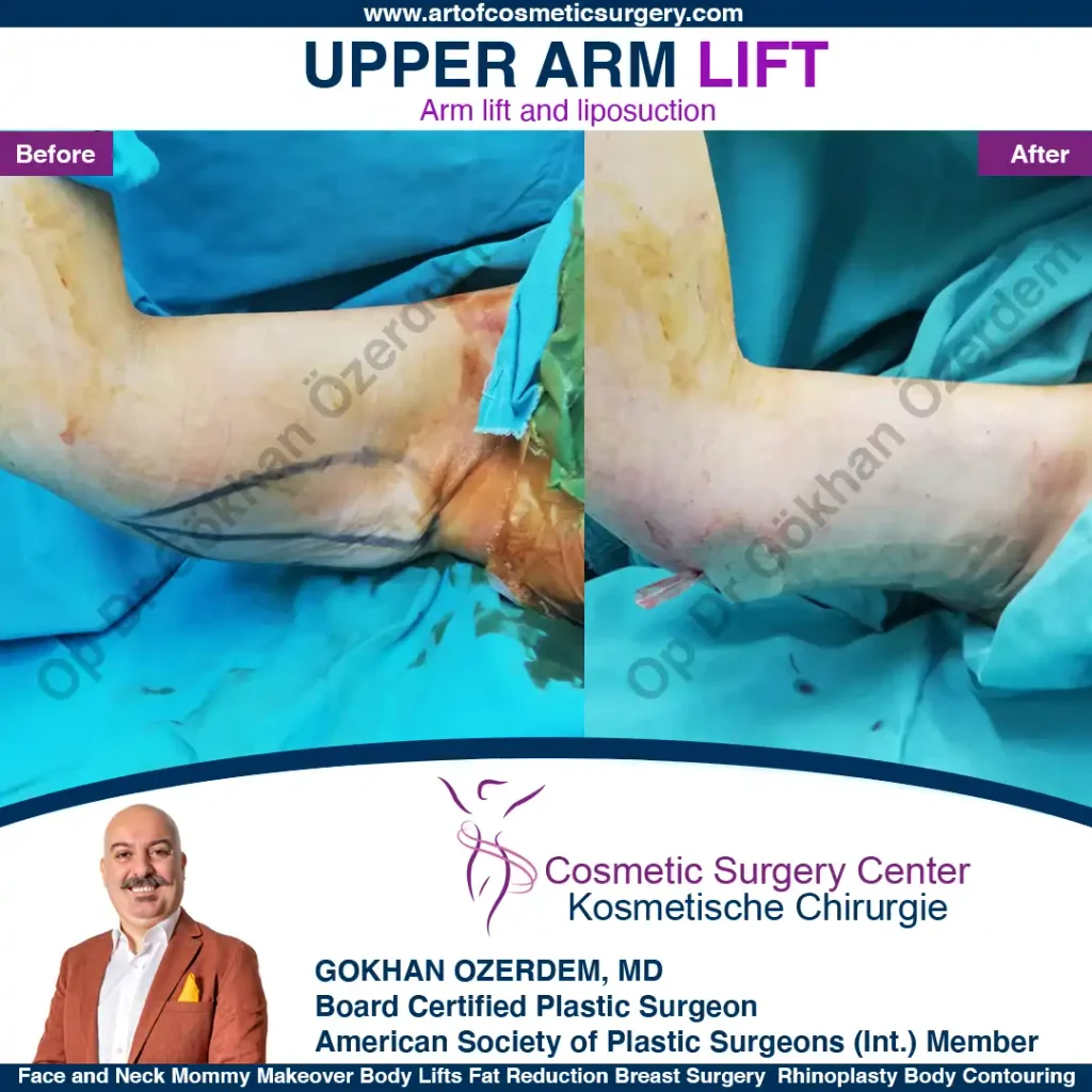 Arm Lift in Turkey, Case 7 - Right Arm