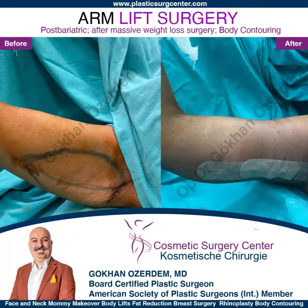 Arm Lift in Turkey, Case 3 - Right Arm