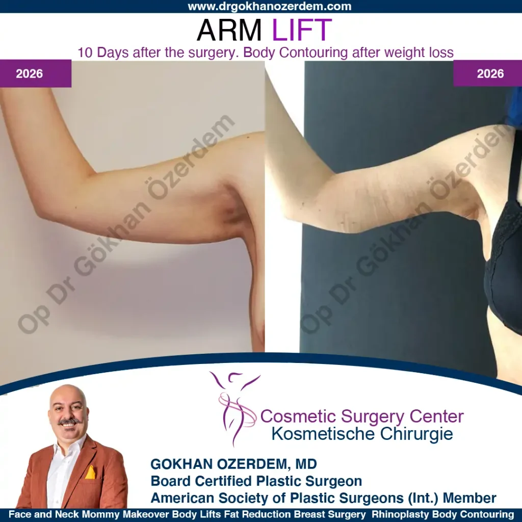 Arm Lift in Turkey, Case 2 - Right Arm
