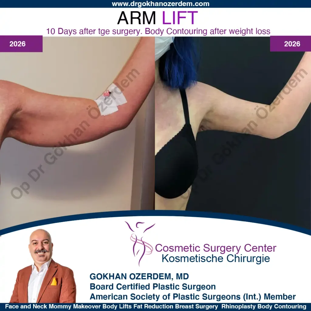 Arm Lift in Turkey, Case 2 - Left Arm
