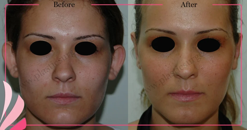 Otoplasty, Prominent ear surgery - Case 7 - Front View