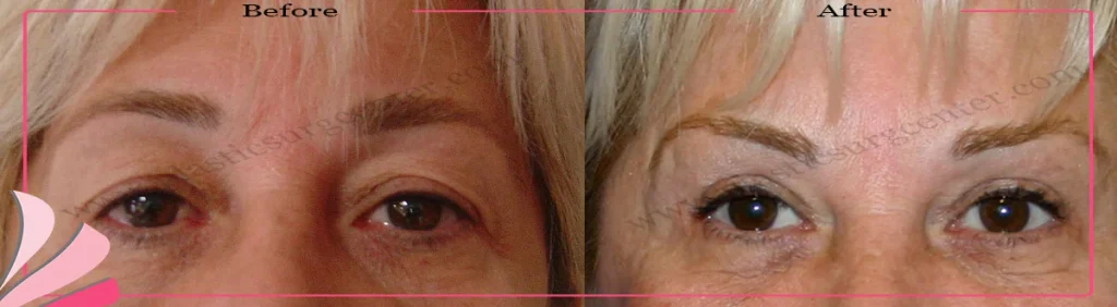 Upper eyelid surgery - case 25 - Front view