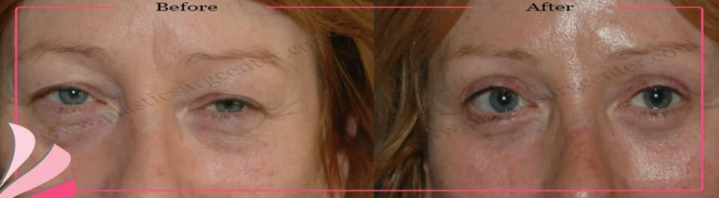 Upper eyelid surgery - case 24 - Front view