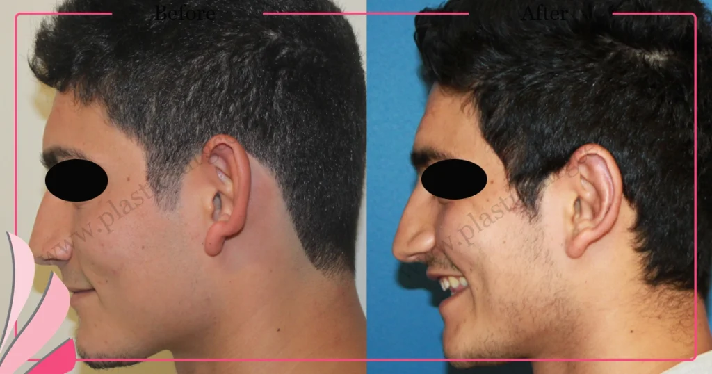 Otoplasty, Prominent ear surgery - Case 3 - Left Profile