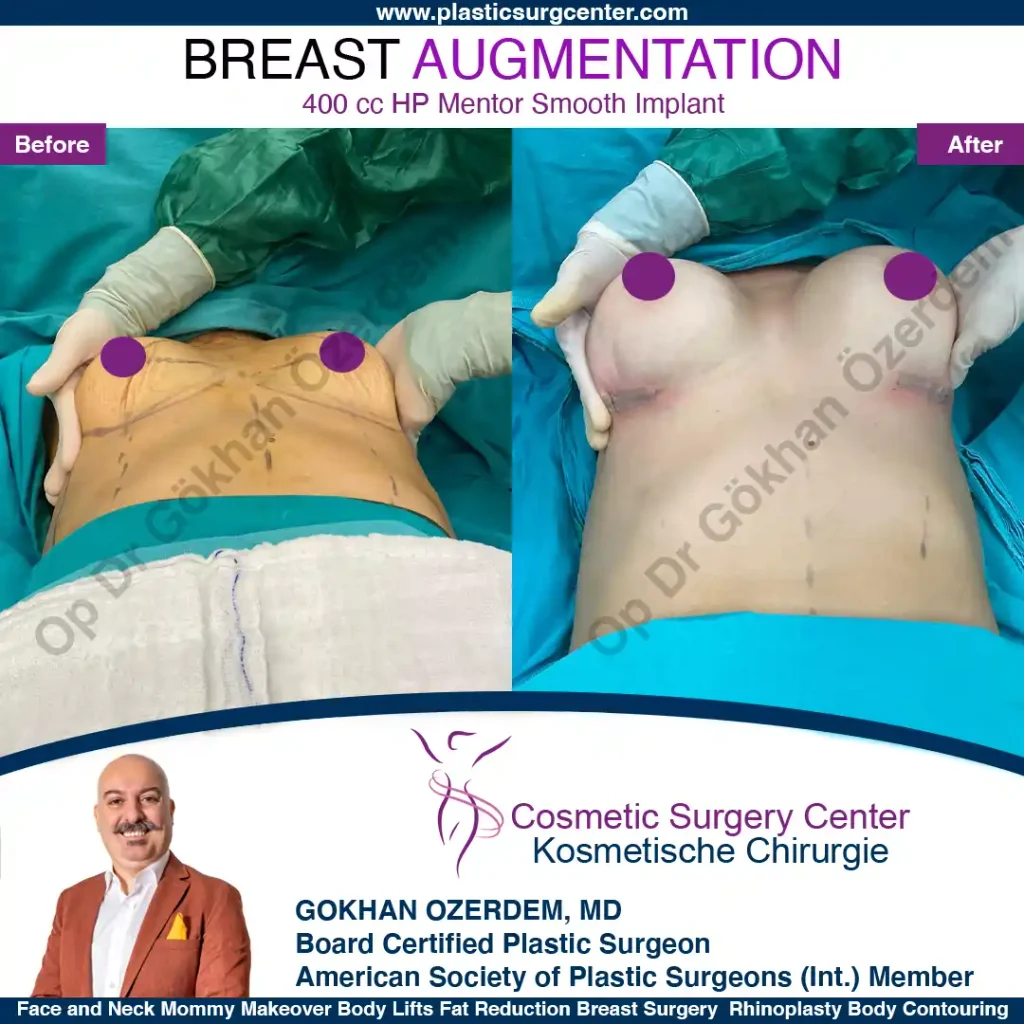 Breast Augmentation in Turkey - Case 27 - Front Side