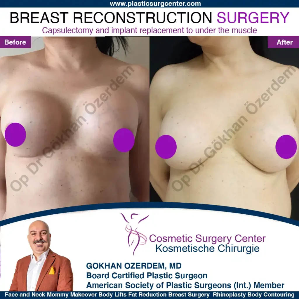 Breast Augmentation in Turkey - Case 49 - Front View