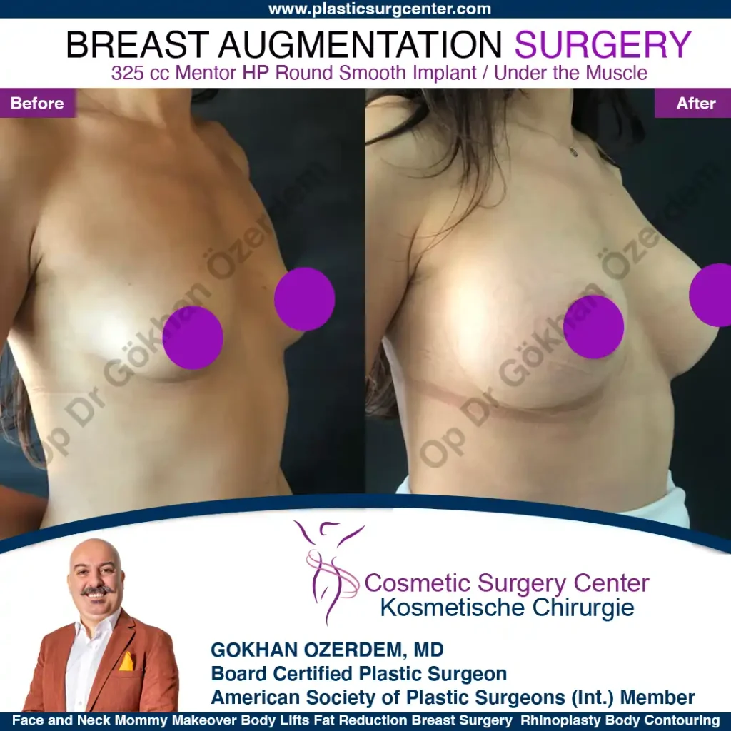 Breast Augmentation in Turkey - Case 48 - Oblique View