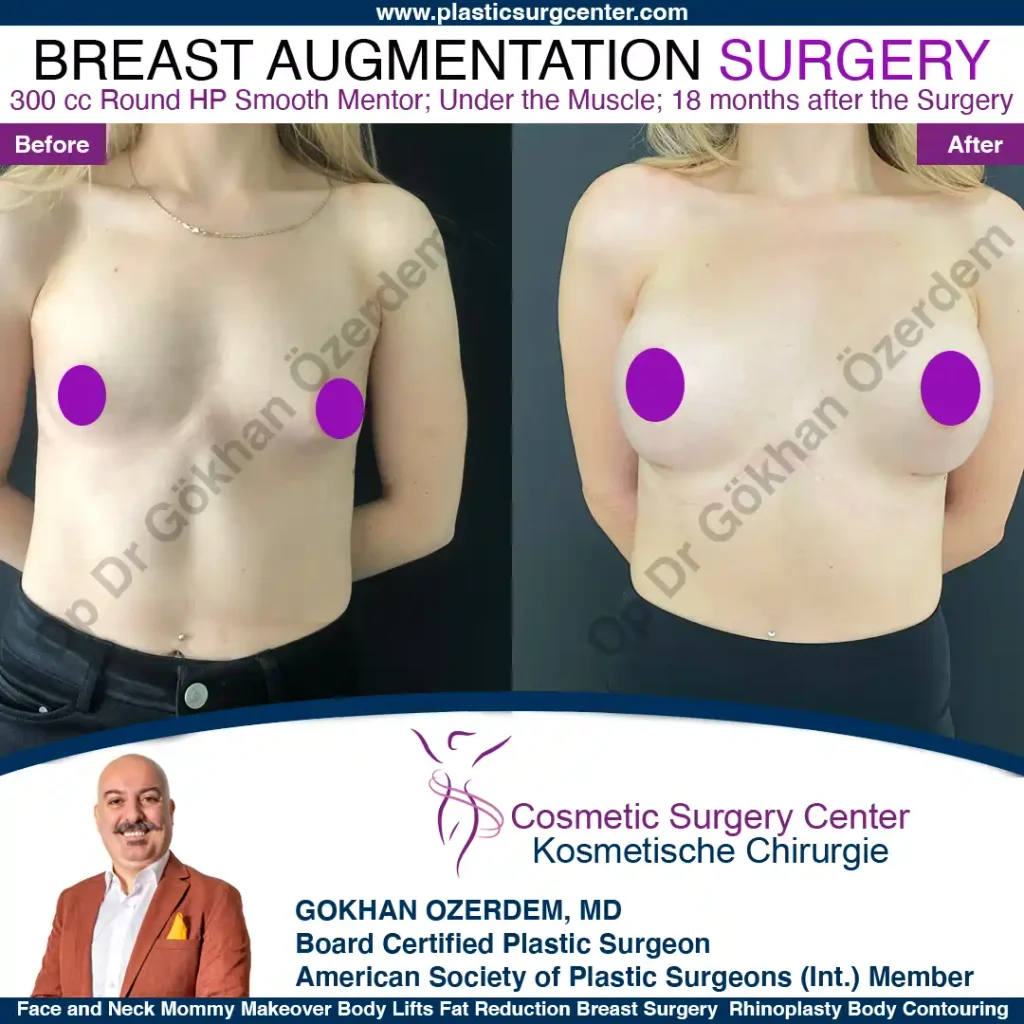 Breast Augmentation in Turkey - Case 47 - Front View