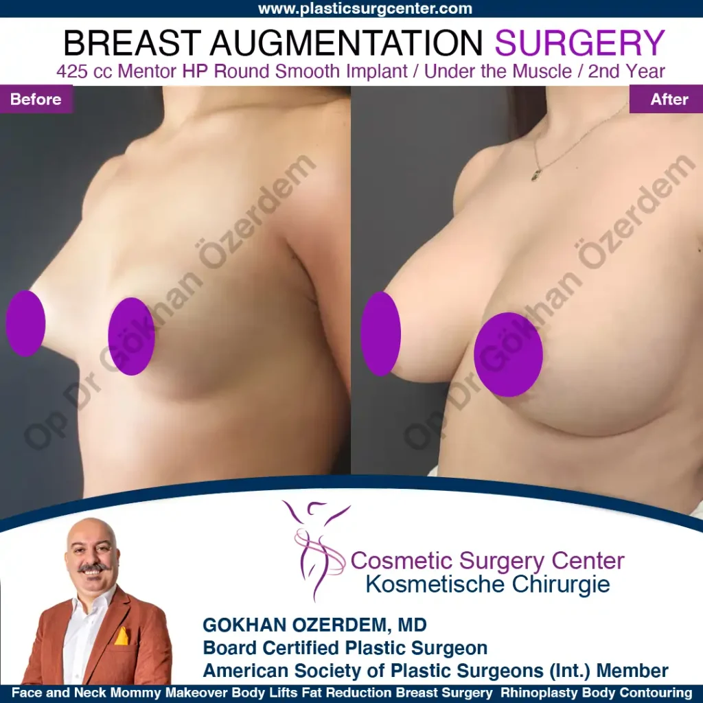 Breast Augmentation in Turkey - Case 46 - Oblique View