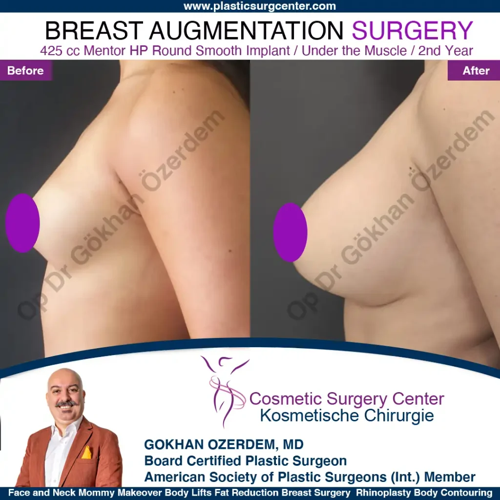 Breast Augmentation in Turkey - Case 46 - Left Side
