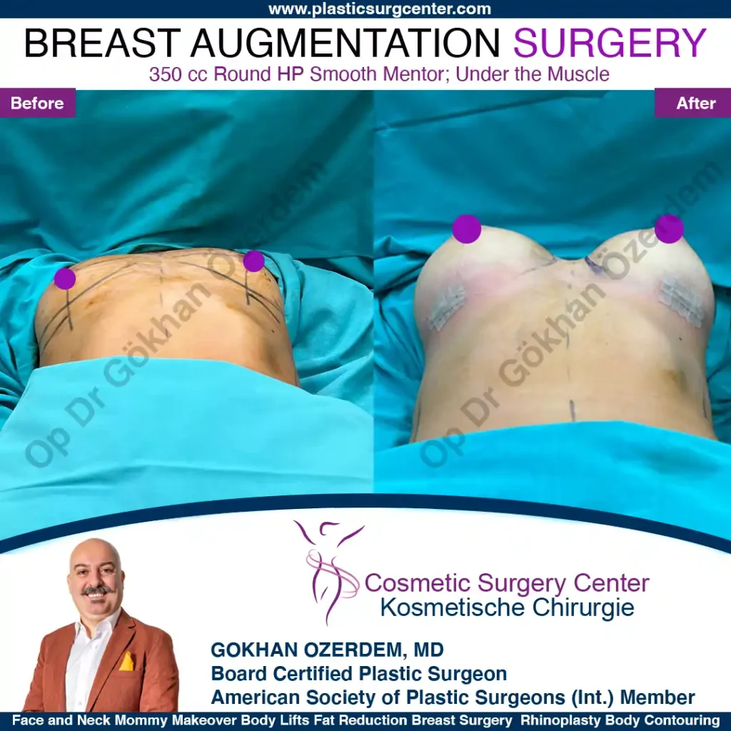 Breast Augmentation in Turkey - Case 45 - Base Side