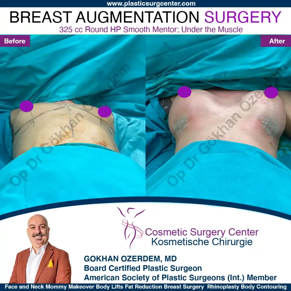 Breast Augmentation in Turkey - Case 34 - Front View