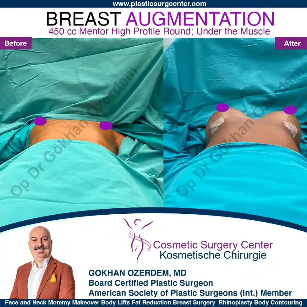 Breast Augmentation in Turkey - Case 44 - Base Side