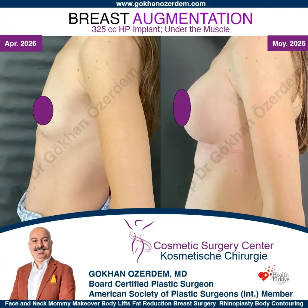Breast Augmentation in Turkey - Case 1 - Left Side