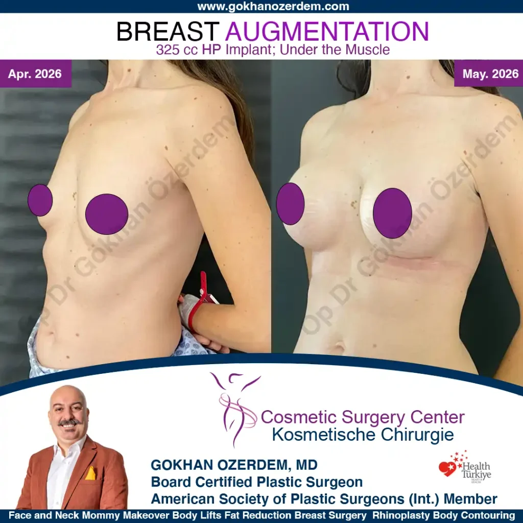 Breast Augmentation in Turkey - Case 1 - Oblique View