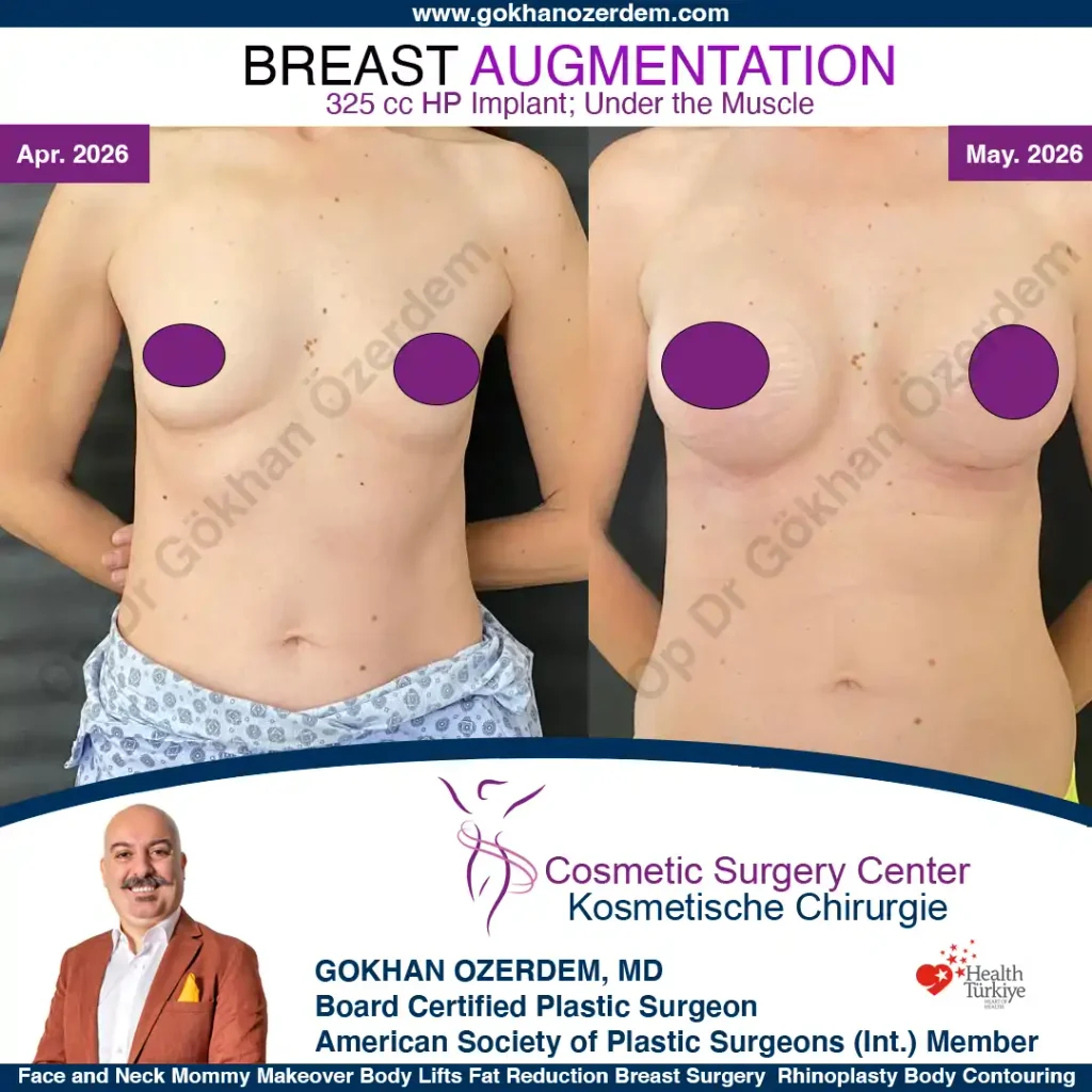 Breast Augmentation in Turkey - Case 1 - Front View