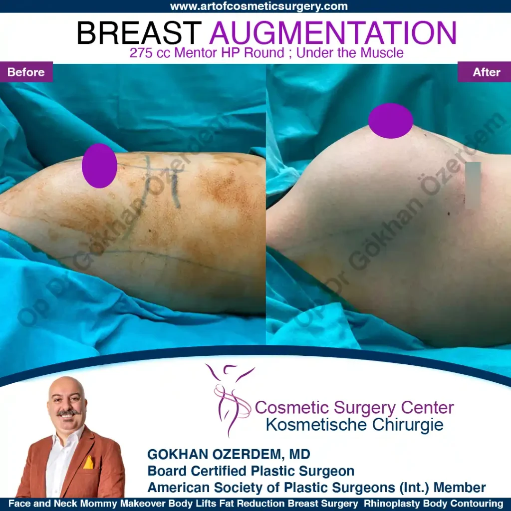 Breast Augmentation in Turkey - Case 43 - Right Side