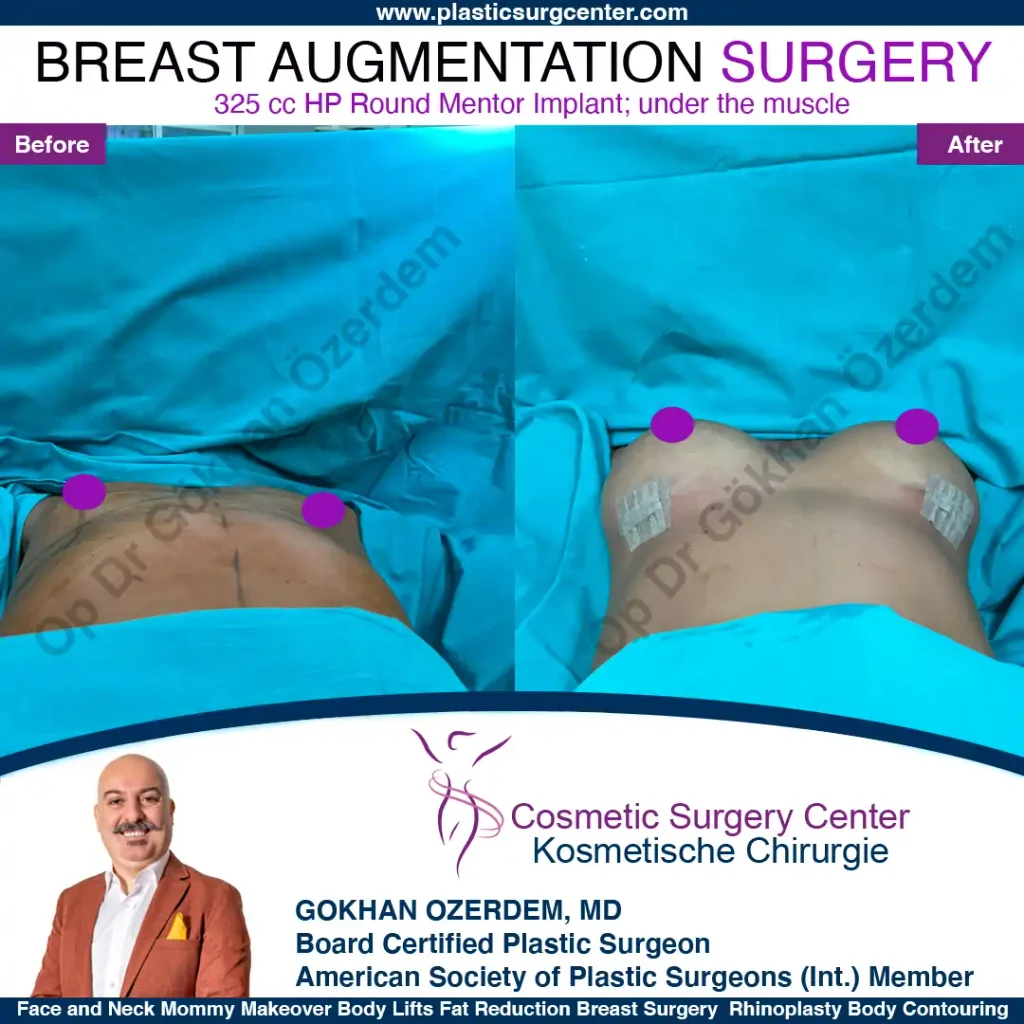 Breast Augmentation in Turkey - Case 42 - Front Side