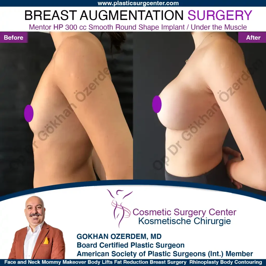 Breast Augmentation in Turkey - Case 41 - Left Side