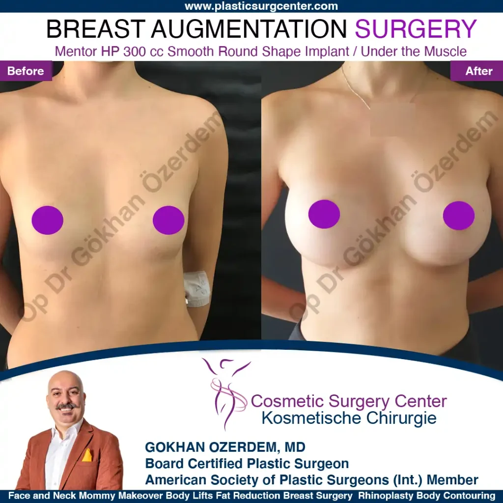 Breast Augmentation in Turkey - Case 41 - Front Side