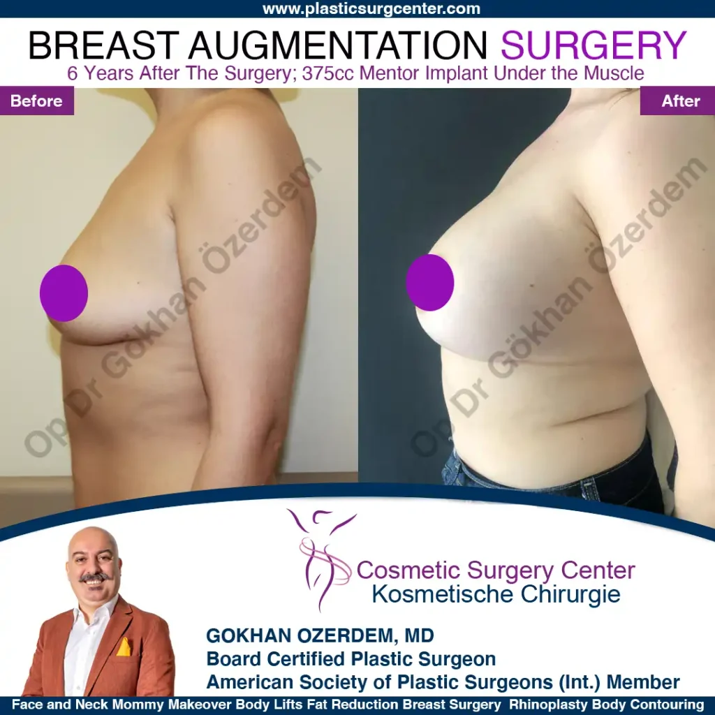 Breast Augmentation in Turkey - Case 40 - Left Side