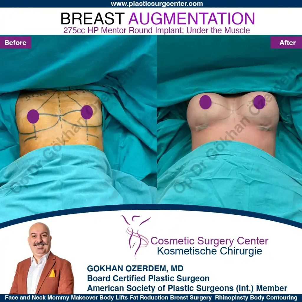 Breast Augmentation in Turkey - Case 24 - Front Side