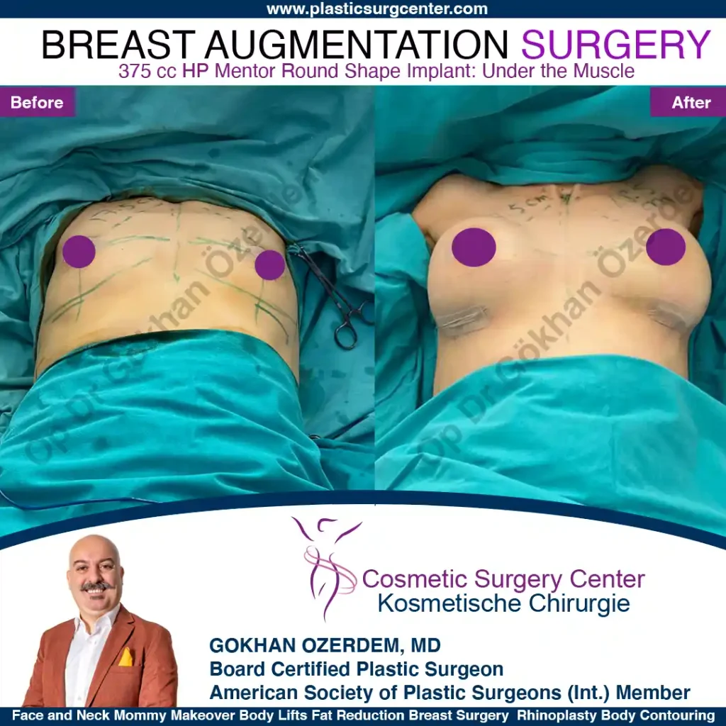 Breast Augmentation in Turkey - Case 23 - Front Side