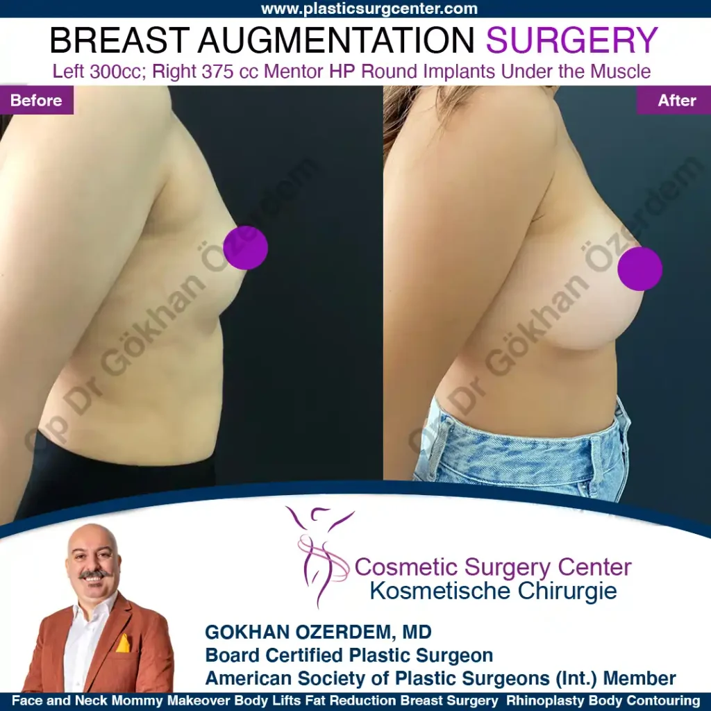 Breast Augmentation in Turkey - Case 39 - Right Side