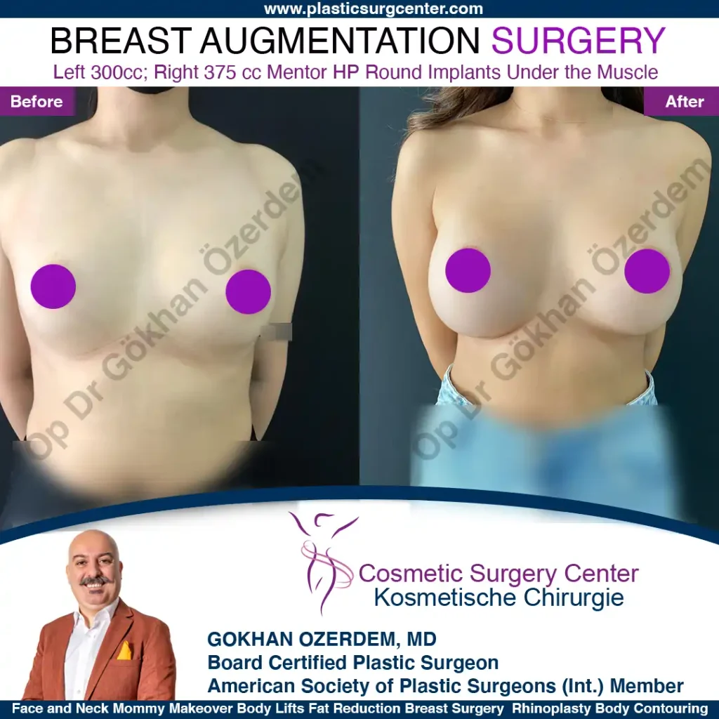 Breast Augmentation in Turkey - Case 39 - Front View