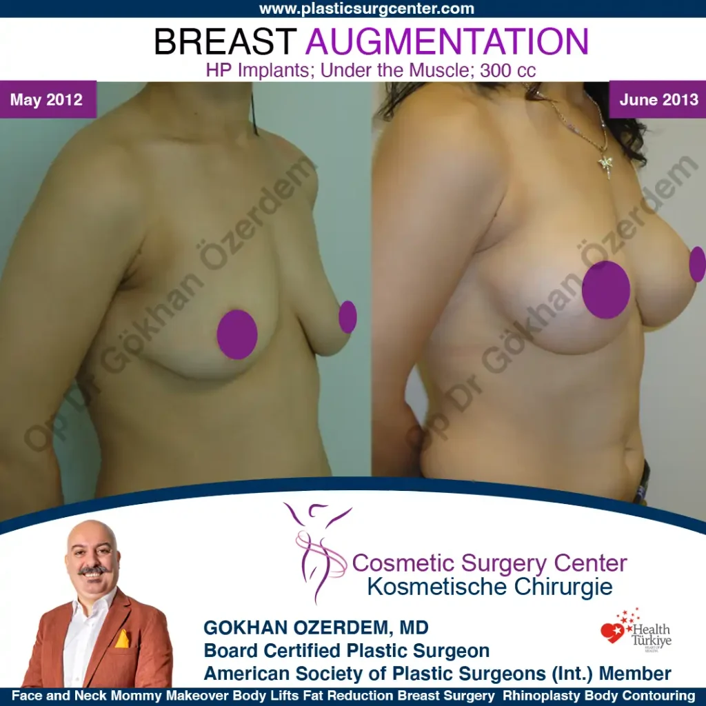 Breast Augmentation in Turkey - Case 16 - Oblique View