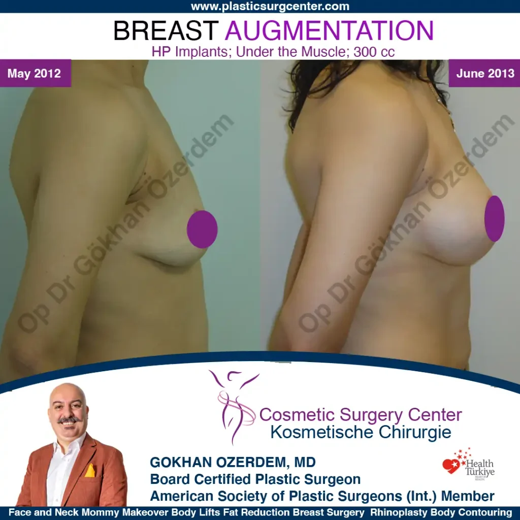 Breast Augmentation in Turkey - Case 16 - Right Side