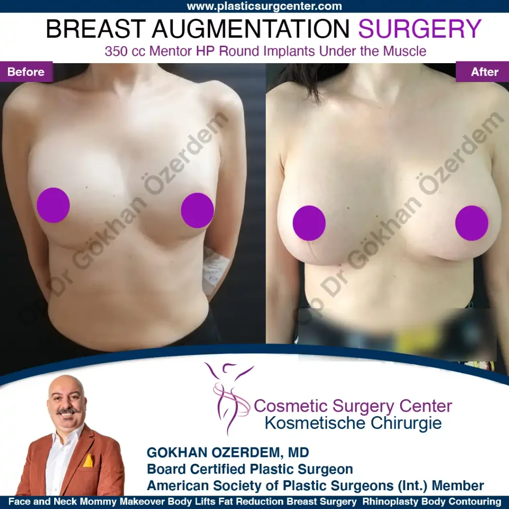 Breast Augmentation in Turkey - Case 38 - Front View