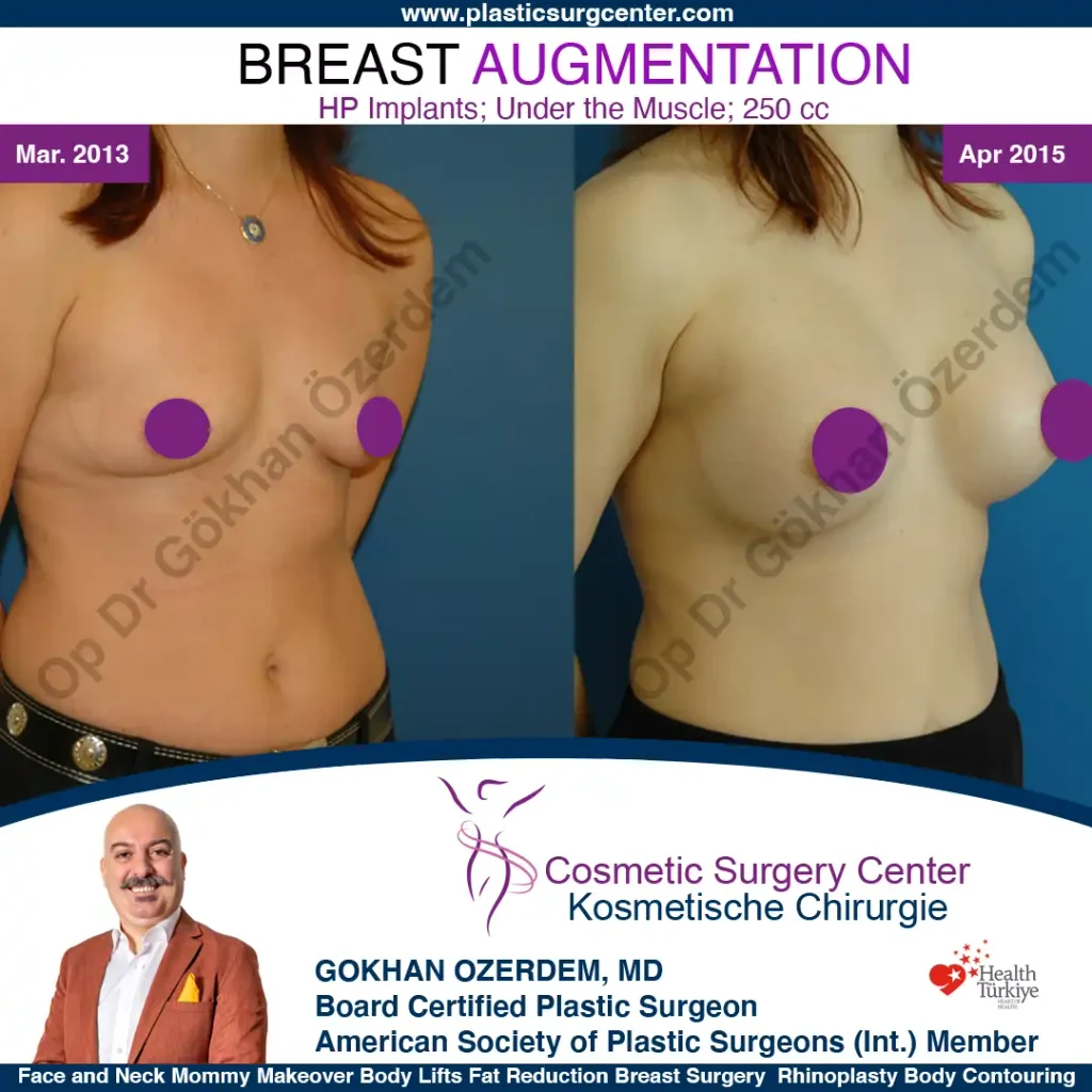 Breast Augmentation in Turkey - Case 15 - Oblique View