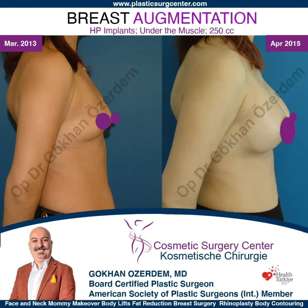 Breast Augmentation in Turkey - Case 15 - Right Side