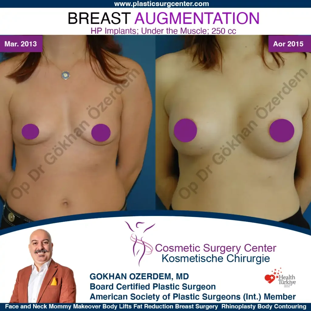 Breast Augmentation in Turkey - Case 15 - Front View