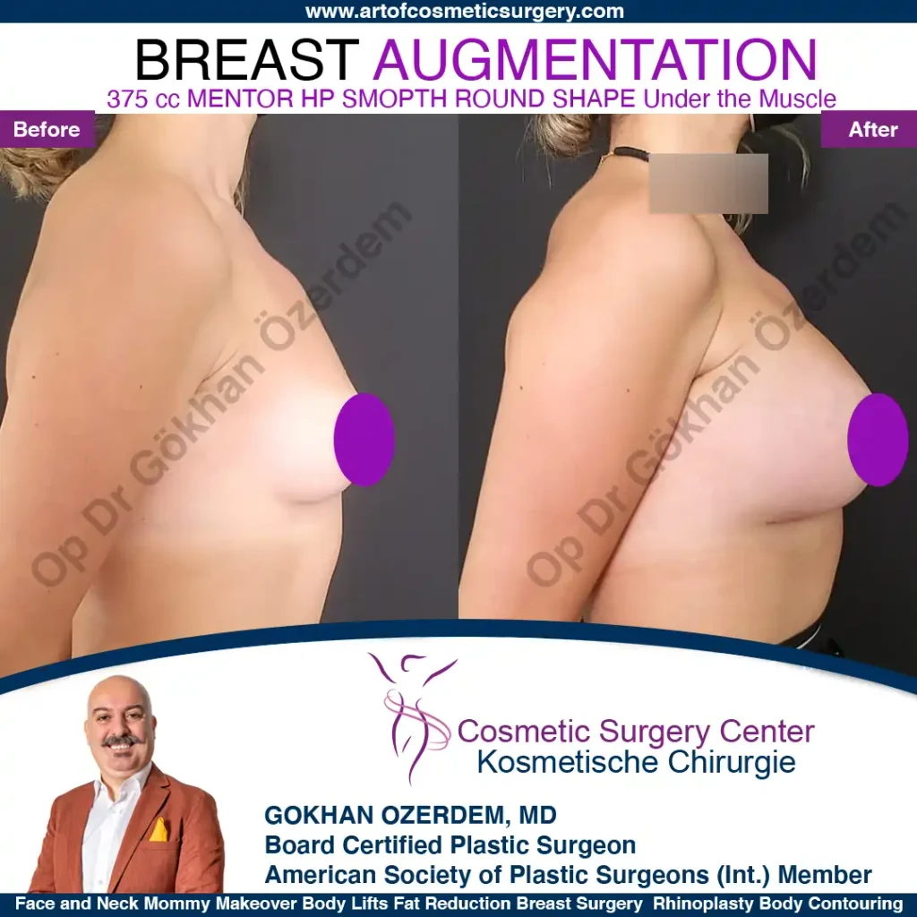 Breast Augmentation in Turkey - Case 37 - Right Side