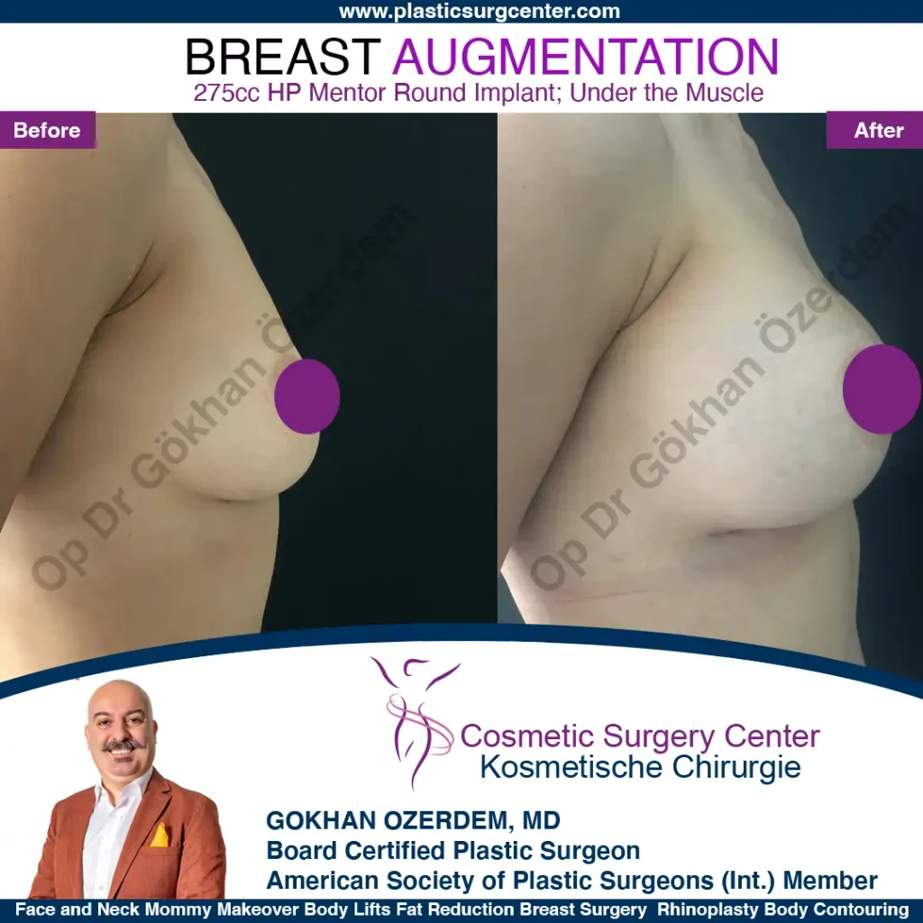 Breast Augmentation in Turkey - Case 14 - Right Side