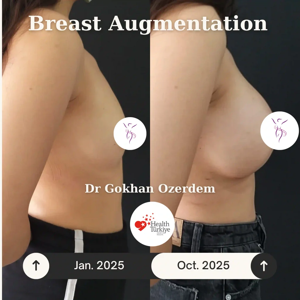 Breast Augmentation in Turkey - Case 33 - Right View