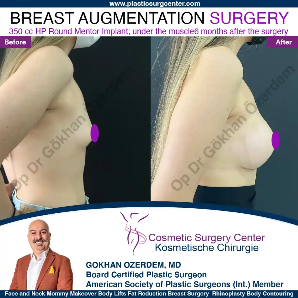 Breast Augmentation in Turkey - Case 36 - Right Side