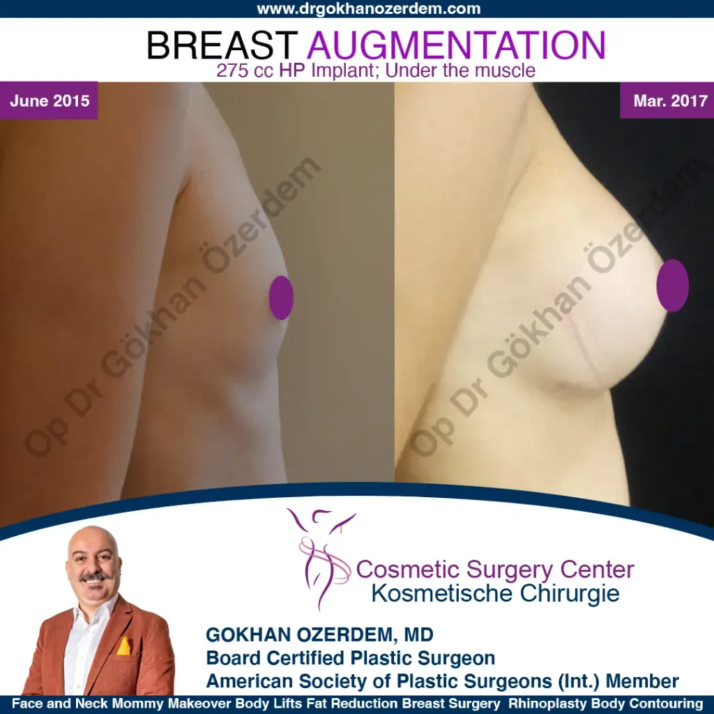 Breast Augmentation in Turkey - Case 13 - Right Side