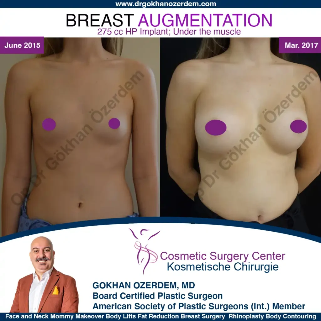 Breast Augmentation in Turkey - Case 13 - Front View