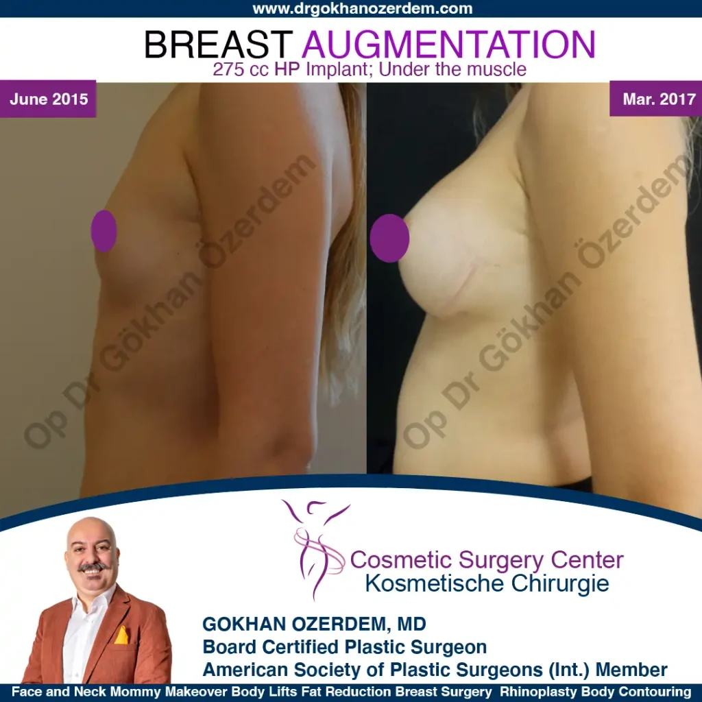 Breast Augmentation in Turkey - Case 13 - Left Side