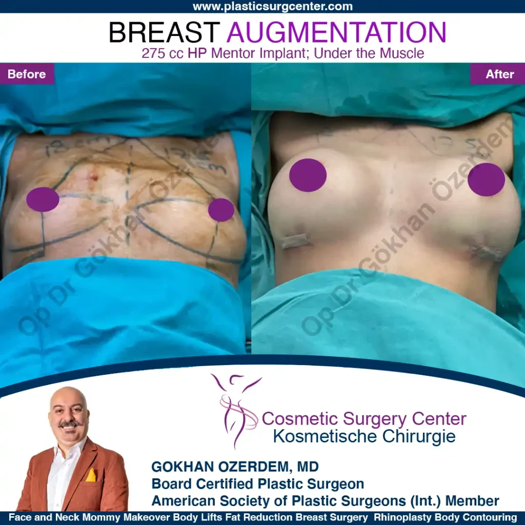 Breast Augmentation in Turkey - Case 22 - Front Side