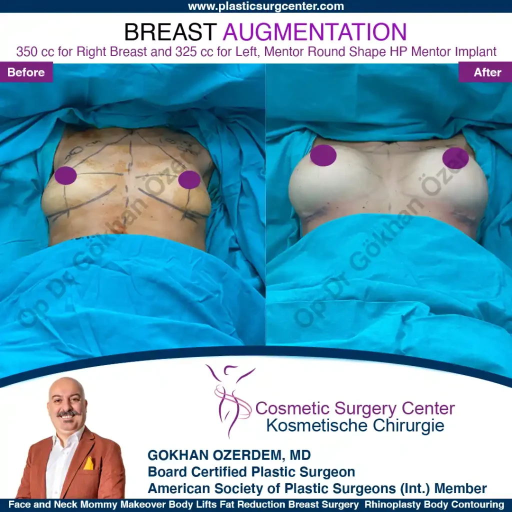 Breast Augmentation in Turkey - Case 26 - Front Side