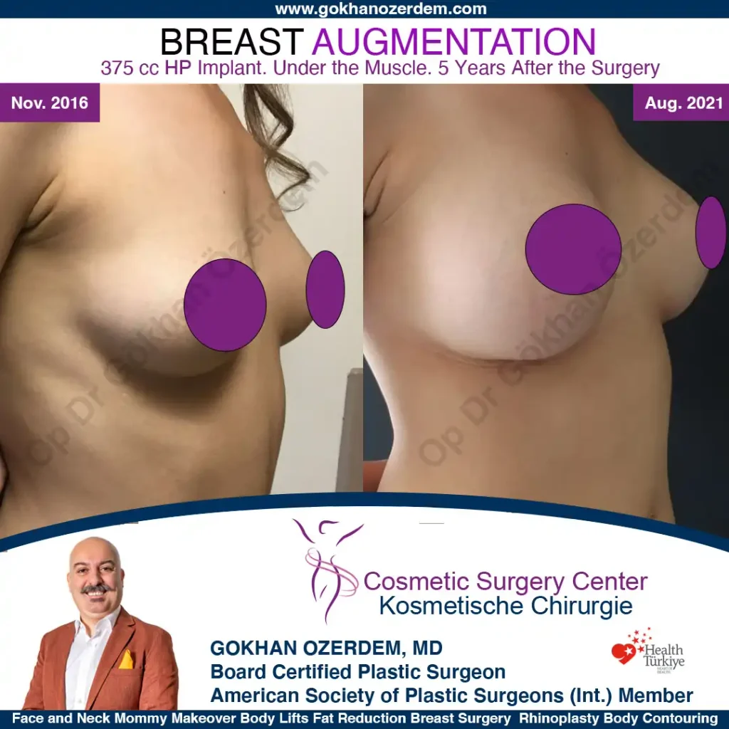Breast Augmentation in Turkey - Case 2 - Right Oblique View