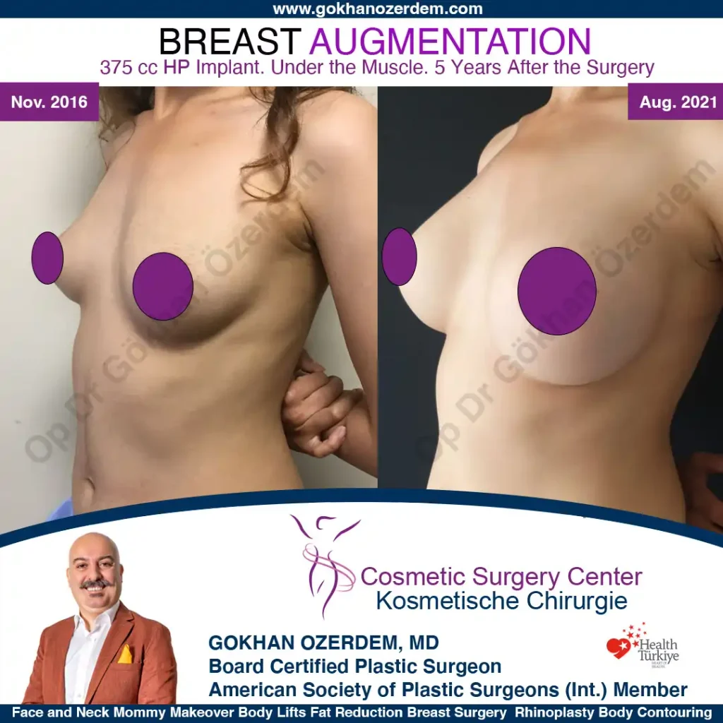 Breast Augmentation in Turkey - Case 2 - Oblique View