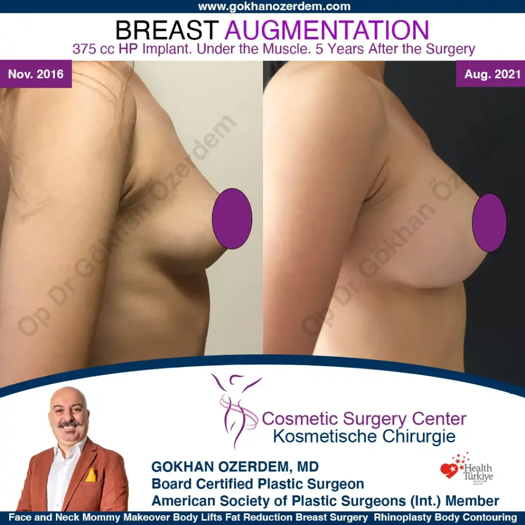 Breast Augmentation in Turkey - Case 2 - Right Side